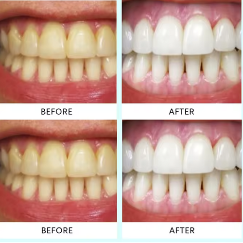 Teeth Whitening Strips (box2)